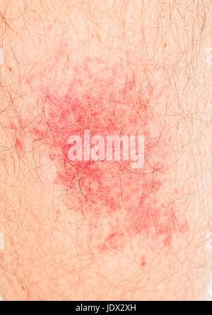 Allergique à la piqûre d'insecte sur la peau humaine Banque D'Images