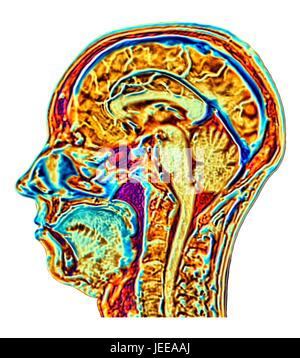 Ordinateur en fausses couleurs améliorée Image par Résonance Magnétique (IRM) d'une coupe sagittale dans la tête d'une normale 46 ans, femme, montrant les structures du cerveau, de la colonne vertébrale et les tissus du visage. Caractéristiques Profil de la partie principale du cerveau : l'alambiqué surface du cortex cérébral, le corps calleux, pons & medulla, structures du tronc cérébral, qui sont en continuité avec la moelle épinière. Le cervelet, le centre de l'équilibre et coordination, se trouve à droite du tronc cérébral. Banque D'Images