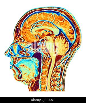 Ordinateur en fausses couleurs améliorée Image par Résonance Magnétique (IRM) d'une coupe sagittale dans la tête d'une normale 46 ans, femme, montrant les structures du cerveau, de la colonne vertébrale et les tissus du visage. Caractéristiques Profil de la partie principale du cerveau : l'alambiqué surface du cortex cérébral, le corps calleux, pons & medulla, structures du tronc cérébral, qui sont en continuité avec la moelle épinière. Le cervelet, le centre de l'équilibre et coordination, se trouve à droite du tronc cérébral. Banque D'Images