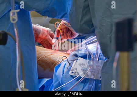 Les mains d'un chirurgien d'effectuer une procédure cardiaque. Photographié à Western General Hospital, Southampton, UK. Banque D'Images