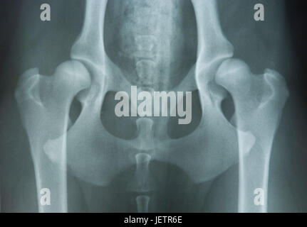 X-ray photo d'un h ?ftgelenkdysplasie avec un 14 mois Hovawartr ?den. H ?ftdysplasie appelle une fausse position de l'articulation de la hanche avec laquelle le chef de Banque D'Images