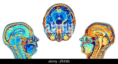 Ordinateur en fausses couleurs améliorée des images par résonance magnétique (IRM) de deux mi-sagittal et un dans l'axe (vue en coupe) sections à travers la tête d'une normale 46 ans, femme, montrant les structures du cerveau, de la colonne vertébrale et les tissus du visage. Caractéristiques Profil de la partie principale du cerveau : l'alambiqué surface du cortex cérébral, le corps calleux, pons & medulla, structures du tronc cérébral, qui sont en continuité avec la moelle épinière. Le cervelet, le centre de l'équilibre et coordination, se trouve à droite du tronc cérébral. Banque D'Images