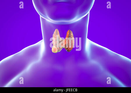 Tumeur de la glande thyroïde, illustration de l'ordinateur. Banque D'Images