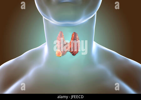 Tumeur de la glande thyroïde, illustration de l'ordinateur. Banque D'Images