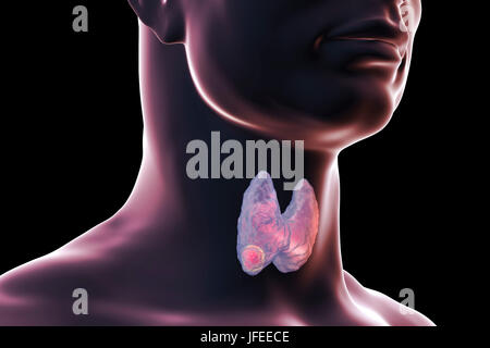 Tumeur de la glande thyroïde, illustration de l'ordinateur. Banque D'Images