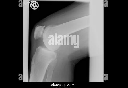 X ray image négative des droits de l'Genou Rhumatismes Banque D'Images