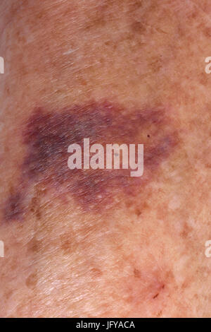 L'hématome sur le bras d'une femme âgée. Banque D'Images