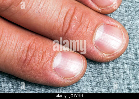 Mens doigts et des ongles en mauvais état close up Banque D'Images