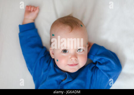 Bébé avec la varicelle on bed Banque D'Images