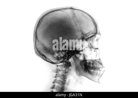 X-ray crâne normal et rachis cervical . Vue latérale . Style couleur Inverser . Banque D'Images