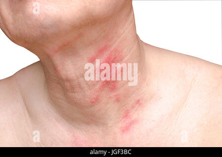 Inflammation de la peau causée par un ulcère avec piqûre d'insecte. Droit isolé sur fond blanc avec chemin de détourage. Banque D'Images