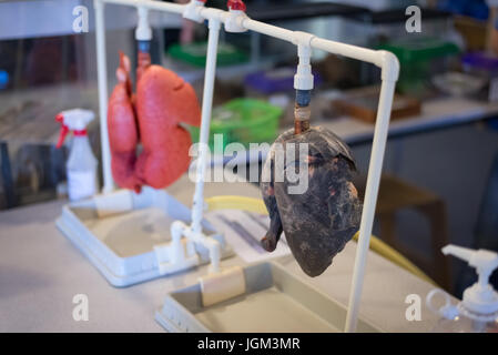 Modèles pulmonaires sains et malades Banque D'Images