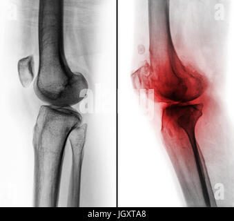 Comparaison entre le genou humain normal ( image de gauche ) et de l'arthrose du genou ( image de droite ) . Vue latérale . Banque D'Images