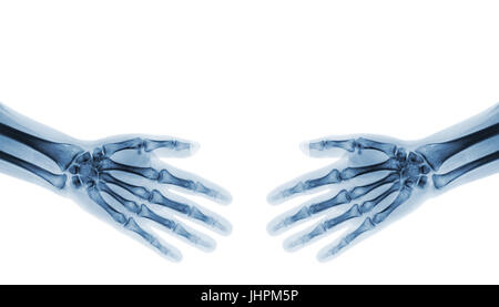 Serrer la main . X-ray mains humaines normales ( zone vide au côté supérieur ) Banque D'Images