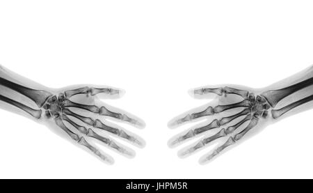 Serrer la main . X-ray mains humaines normales ( zone vide au côté supérieur ) Banque D'Images