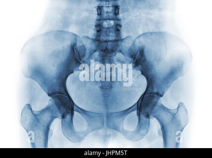 Film x-ray de bassin humain normal et les articulations de la hanche . Banque D'Images