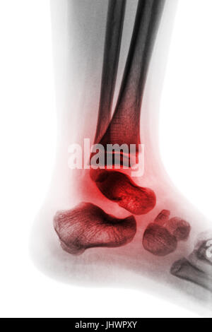 L'arthrite de cheville . X-ray de la cheville de l'enfant et enflamment les . Vue latérale . ( Notion de la polyarthrite rhumatoïde juvénile ) Banque D'Images