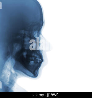 Film x-ray de crâne humain normal . vue latérale . zone vide du côté droit . Banque D'Images