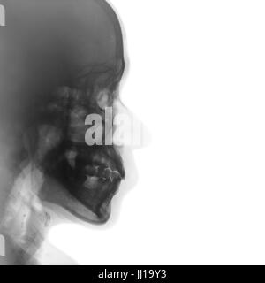 Film x-ray de crâne humain normal . vue latérale . zone vide du côté droit . Banque D'Images