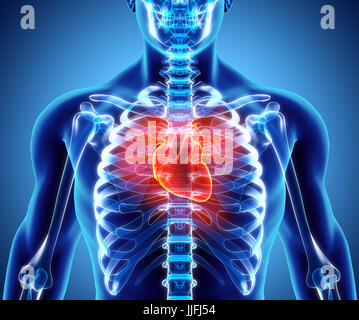3D illustration de l'insuffisance cardiaque - partie des droits de l'organique. Banque D'Images
