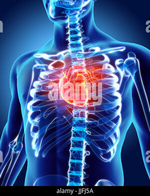 3D illustration de l'insuffisance cardiaque - partie des droits de l'organique. Banque D'Images