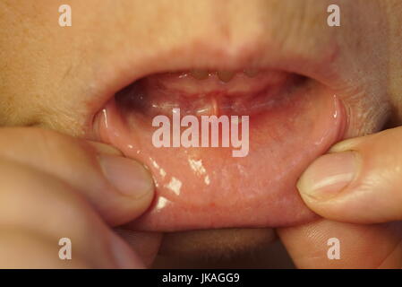 Stomatite vésiculeuse dans la bouche sur la lèvre inférieure. Close-up Banque D'Images