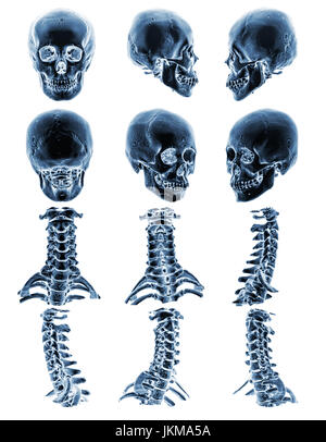 Tomodensitométrie La tomodensitométrie ( ) avec 3D, crâne humain normal et rachis cervical . Plusieurs avis . Banque D'Images