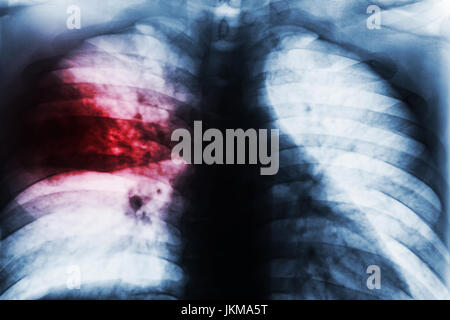 La pneumonie lobaire . Poitrine Film x-ray show inégal infiltrer au milieu droit de poumon infection à Mycobacterium tuberculosis tuberculose pulmonaire ( ) . Banque D'Images