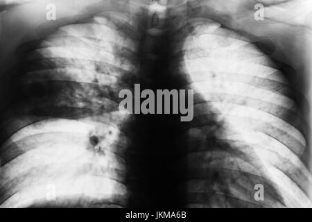 La pneumonie lobaire . Poitrine Film x-ray show inégal infiltrer au milieu droit de poumon infection à Mycobacterium tuberculosis tuberculose pulmonaire ( ) . Banque D'Images