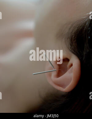 Un traitement d'acupuncture photo en gros plan d'un traitement d'acupuncture photo en gros plan Banque D'Images