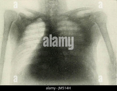 'Radio-diagnostic de l'affection pulmonaire pleuro-' (1918) Banque D'Images