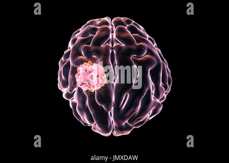 Image conceptuelle pour le traitement du cancer du cerveau. Illustration d'ordinateur montrant la destruction de tumeur au cerveau. Banque D'Images