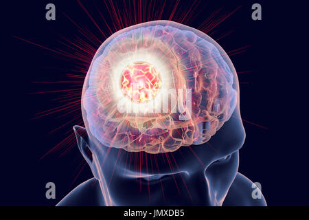 Image conceptuelle pour le traitement du cancer du cerveau. Illustration d'ordinateur montrant la destruction de tumeur au cerveau. Banque D'Images