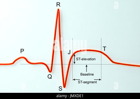 Électrocardiogramme (ECG) lors d'un infarctus du myocarde (crise cardiaque). Illustration d'ordinateur montrant ST-elevation qui est mesurée à l'ou jonctionnelle J-point. La mention de droit. Banque D'Images