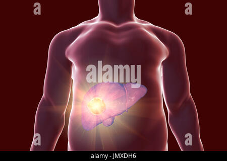 Traitement du cancer du foie, de l'image conceptuelle. Banque D'Images
