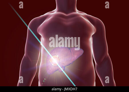 Traitement du cancer du foie, de l'image conceptuelle. Banque D'Images