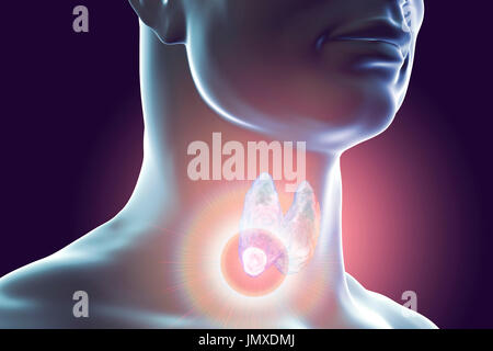 La destruction des tumeurs de la thyroïde, l'illustration de l'ordinateur. Image conceptuelle pour les nodules thyroïdiens et le traitement du cancer. Banque D'Images