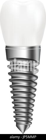 Implant dentaire isolé sur un fond blanc. Vector Illustration. Illustration de Vecteur