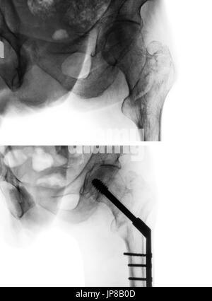 Intertrochanteric fémur fracture ( os de cuisse ). X-ray de hanche et comparaison entre avant la chirurgie (coin supérieur droit) et après la chirurgie (image inférieure). Pat Banque D'Images