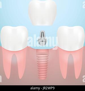 Les dents et les implants dentaires isolé sur un arrière-plan. Vector Illustration. Illustration de Vecteur