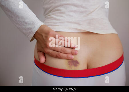 Ecchymose. Femme tenir sa main sur la colonne vertébrale à cause de la douleur Banque D'Images