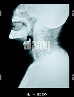 X ray d'un cou, cervical. Banque D'Images