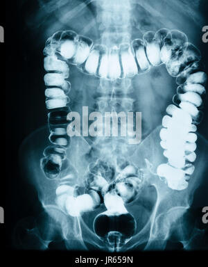 L'obstruction de l'intestin 'Small' Film X-ray abdomen supine Banque D'Images