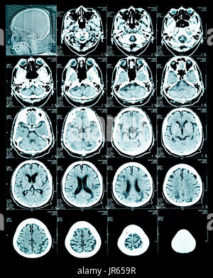 Irm cérébrale pour le diagnostic de l'image Banque D'Images