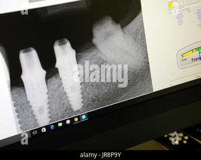 Vu sur l'écran d'un ordinateur écran est dentiste's digital X-ray montrant deux nouveaux postes de soins dentaires (vissée) implantés dans l'ancrage de la mâchoire inférieure qui couronnes dentaires porcelaine pour remplacer ses dents naturelles qui avait diminué au-delà de la réparation. Banque D'Images