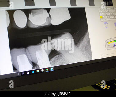 Vu sur l'écran d'un ordinateur écran est un dentiste's digital X-ray montrant différents remplissages dentaires sur les dents d'en haut, et trois nouvelles couronnes en porcelaine sur deux postes d'implant dentaire (à gauche) et l'autre sur une dent naturelle (droite) de la mâchoire inférieure. Banque D'Images
