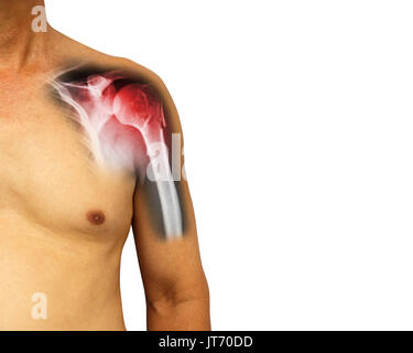 Les droits de l'épaule avec x-ray montrent la rupture à col de l'humérus (os du bras ) . Fond isolé . Zone vide du côté droit . Banque D'Images