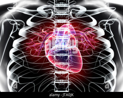 3D illustration de l'insuffisance cardiaque - partie des droits de l'organique. Banque D'Images
