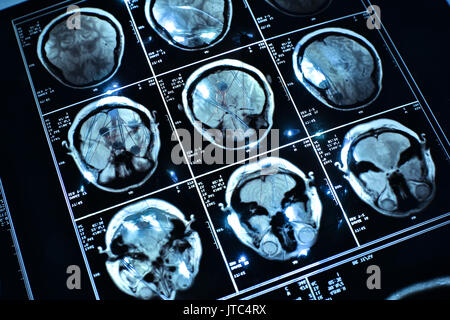 Le fil sur le cerveau medical x-ray Banque D'Images