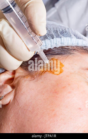 Le dermatologue effectue une anesthésie locale pour préparer le patient pour le visage pour le visage avec de l'acide lactique poly ligne - Selective focus Banque D'Images